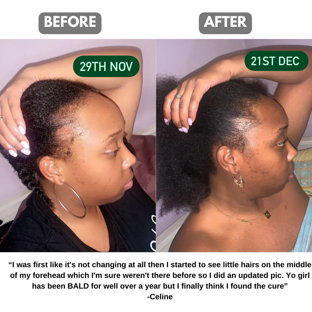 The Ultimate Hair Growth Set for Black Hair - Image 3