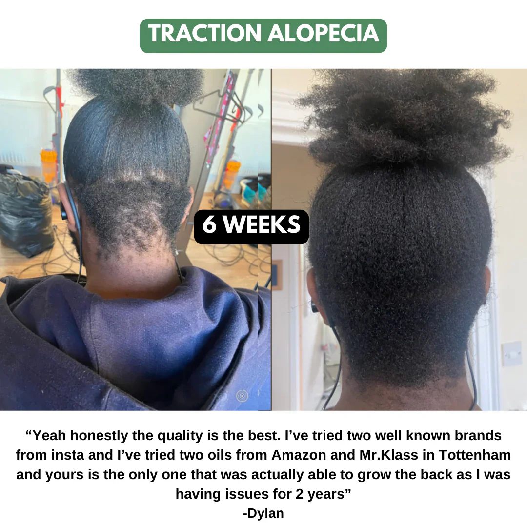 The Ultimate Hair Growth Set for Black Hair - Image 5